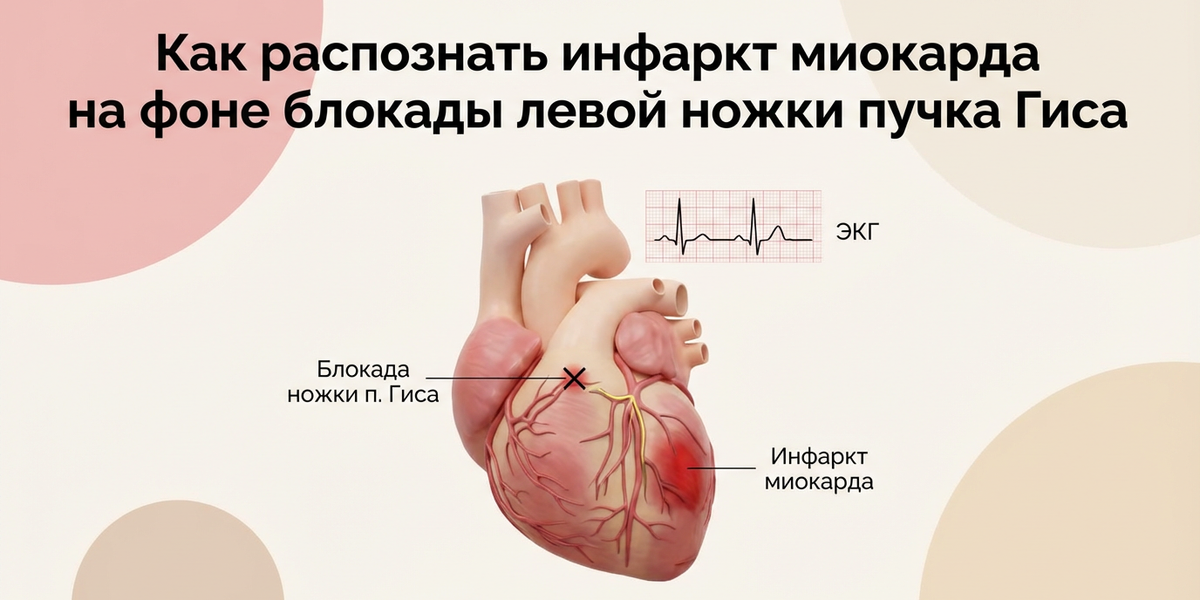 Как распознать инфаркт миокарда на фоне блокады левой ножки пучка Гиса